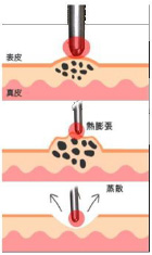 腫瘍の蒸散画像1