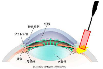 緑内障の治療画像1