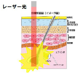 逆まつ毛治療画像1