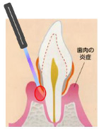 歯周病治療画像1